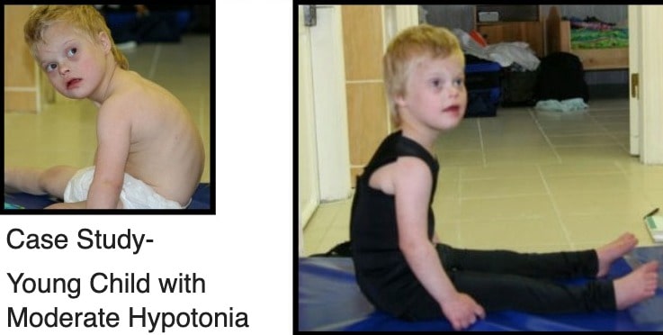 SPIO Compression Orthosis | Case Study: Young Child with Moderate Hypotonia